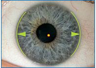 Нецентральность оптической оси глаза