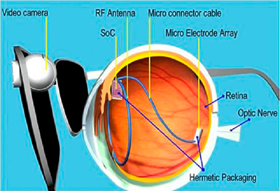 Бионический глазной имплант
