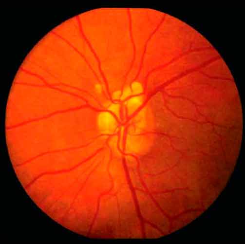 Патология зрительного нерва в структуре диагностических ошибок при направлении пациентов на хирургическое лечение катаракты